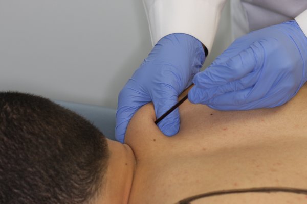 Certification in Dry Needling & Electric Dry Needling for the Spine & Extremities  (DNc)™